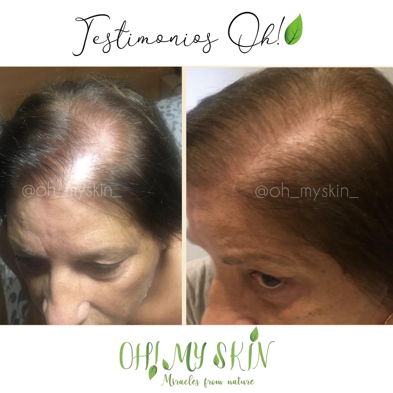 DÚO ALOPECIA