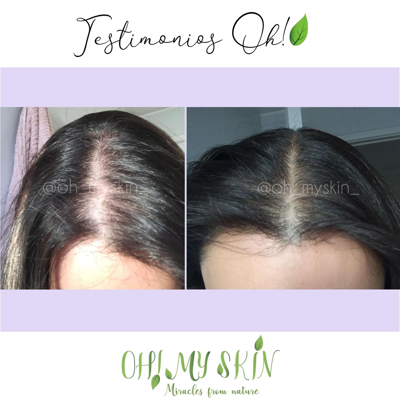 DÚO ALOPECIA